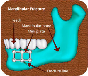 mandibular-fracture-drawing