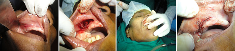 Maxillary-cyst-removal-stages