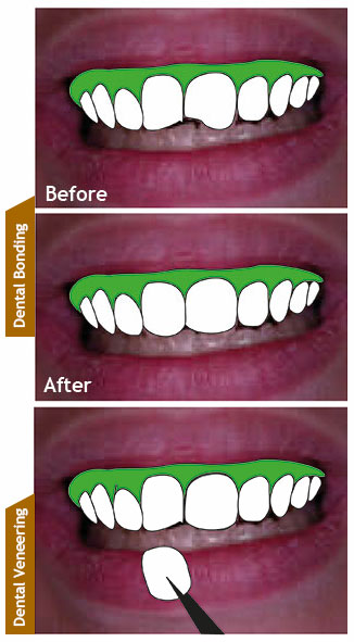 dental-bonding-veneering-drawing