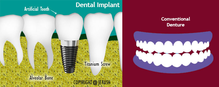 dental-implant-or-denture