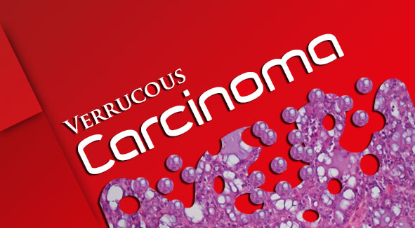 verrucous-carcinoma-cover