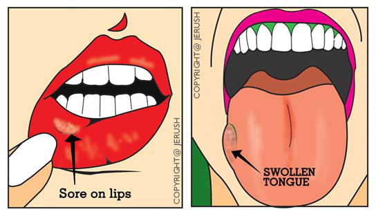 oral-cancer-mouth=cancer-drawing