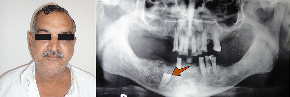 impacted-premolar-balram