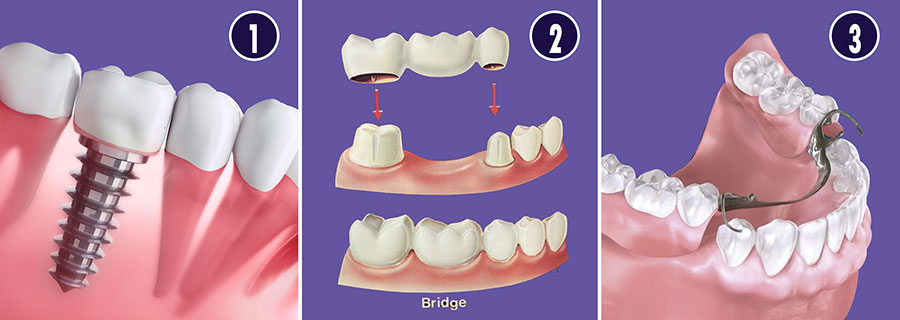 tooth-replacements