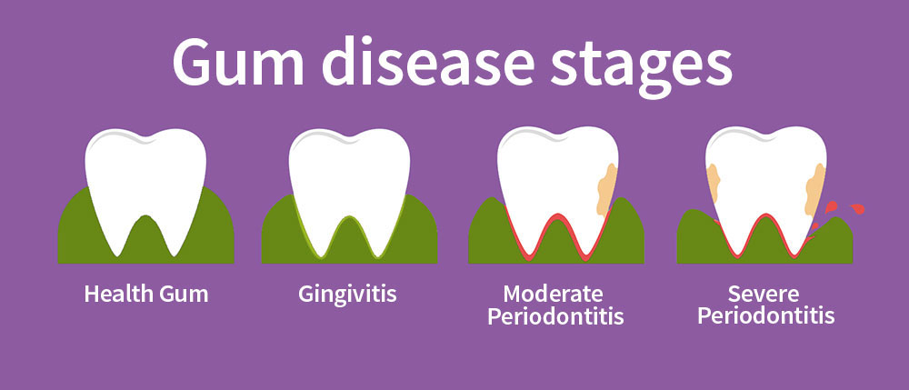 gum disease-stages