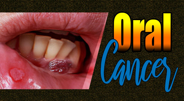 oral-cancer-cover