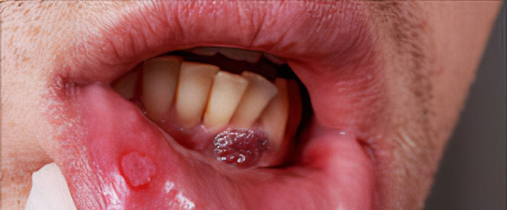 oral-cancer