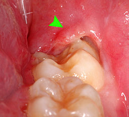 pericoronitis-mage