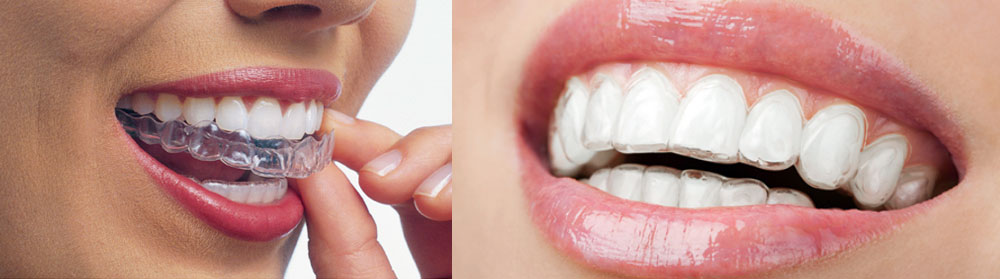 invisalign-jerush-dental