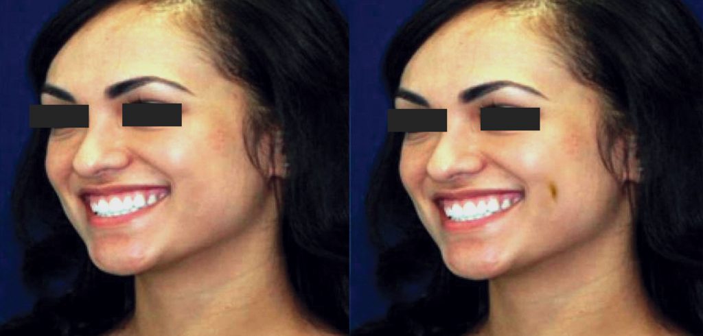 dimple-creation-cosmetic-treatment