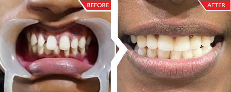 dental-veneers-before-after