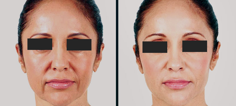 fillers-cosmetic-treatment