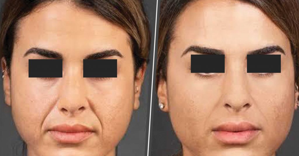 wrinkle-correction-treatment-thuckalay