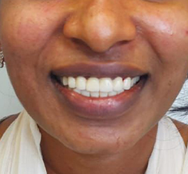 Jerush Treatment Before after