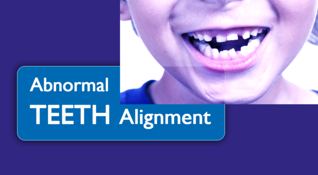 malocclusion