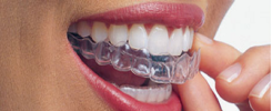 Invisalign in Chennai