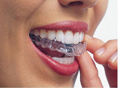 Invisalign in Chennai