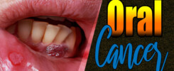 oral-cancer-cover