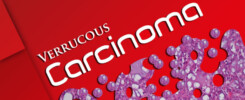 verrucous-carcinoma-cover